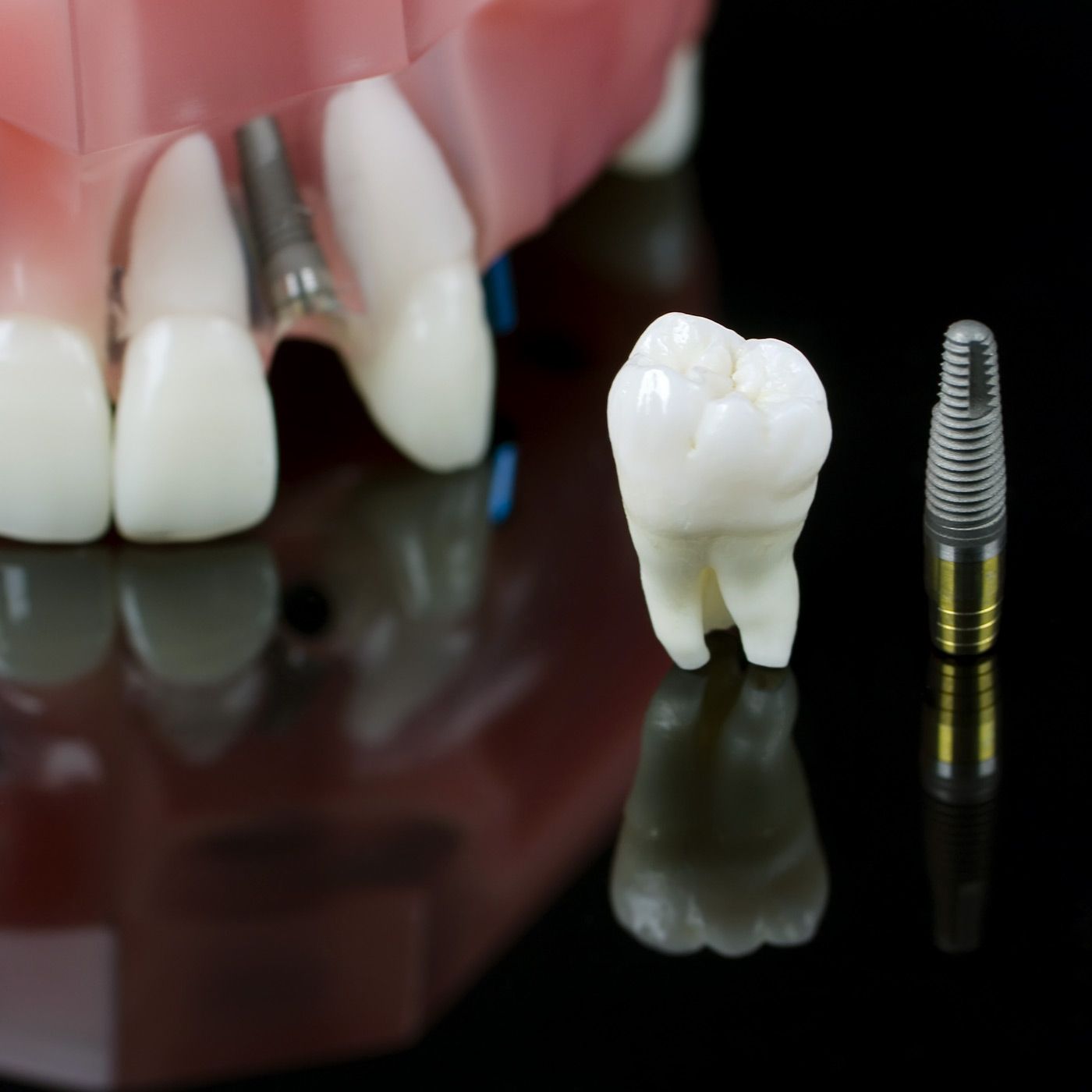 Model of jaw and implant