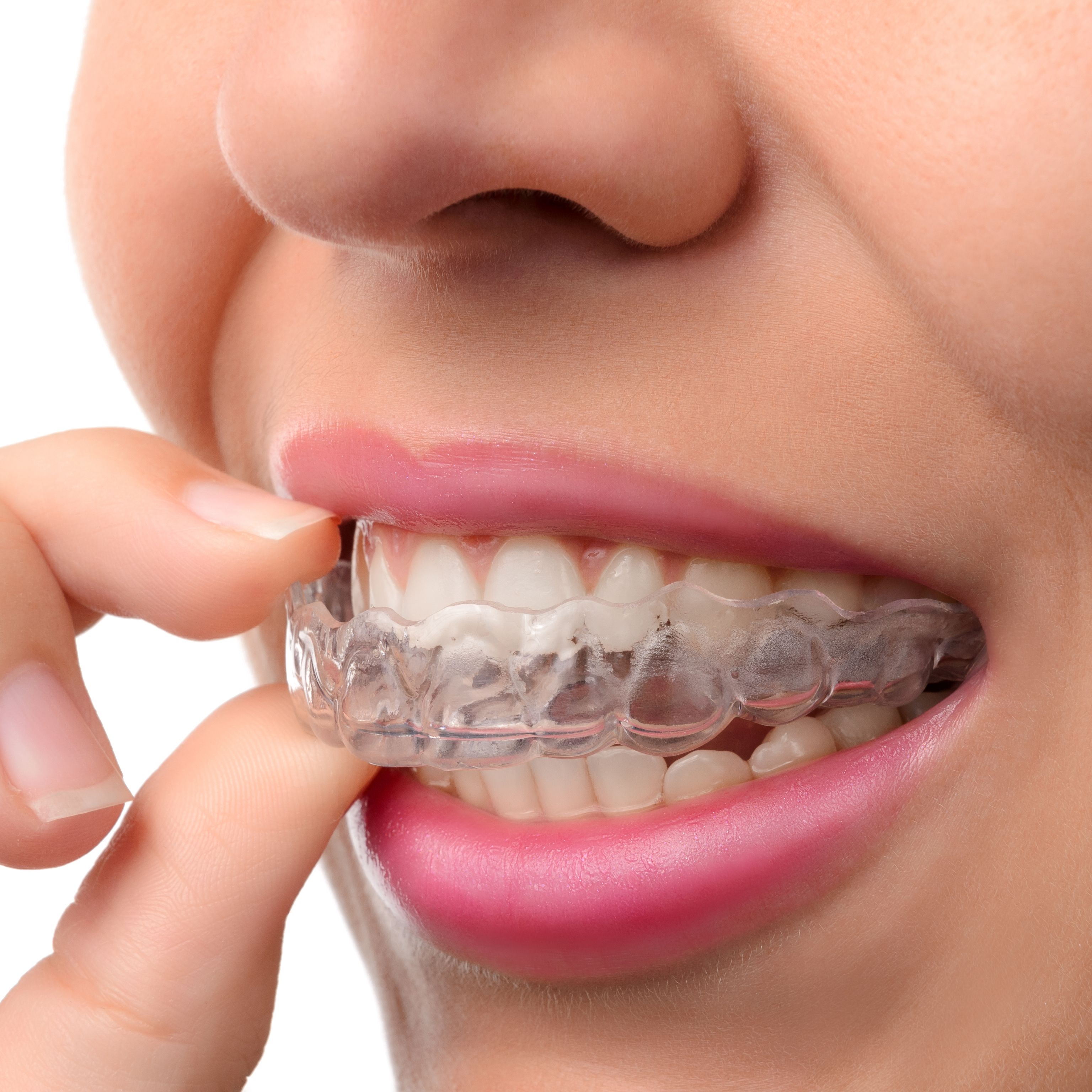 Woman inserting Invisalign tray