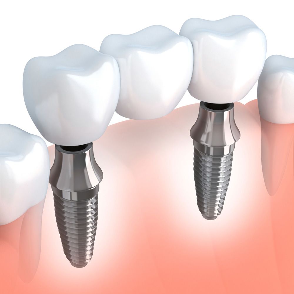 Digital illustration of an implant-supported bridge